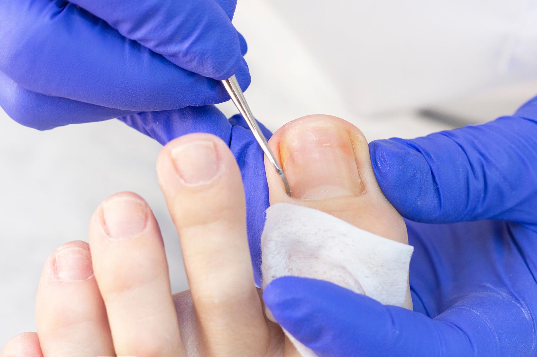 Toenail Fungus Signs