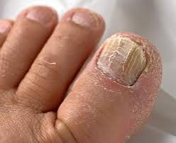 Toenail Fungus Signs: Safety Tips